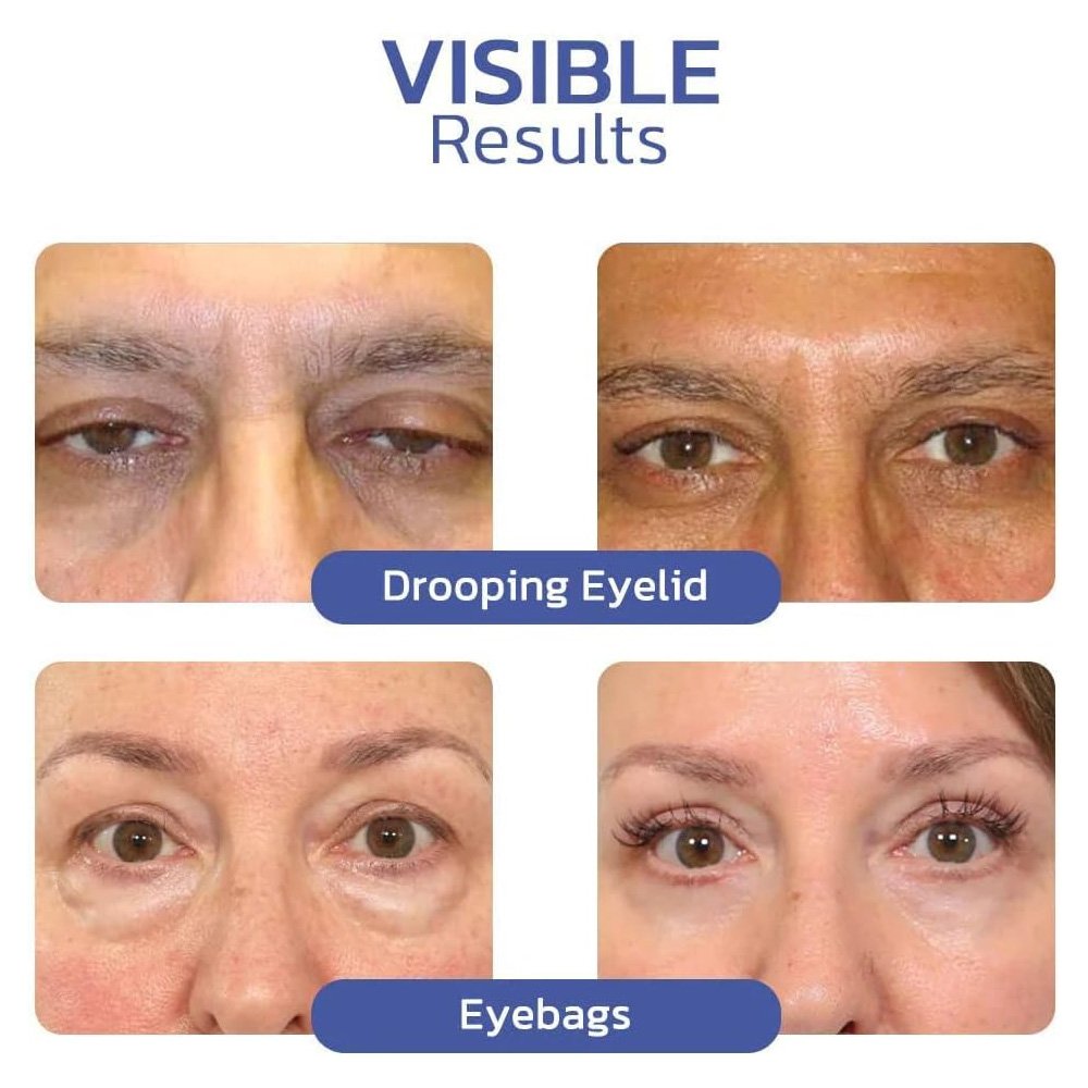 كريم التخلص من تجاعيد منطقة العين - الصورة 3